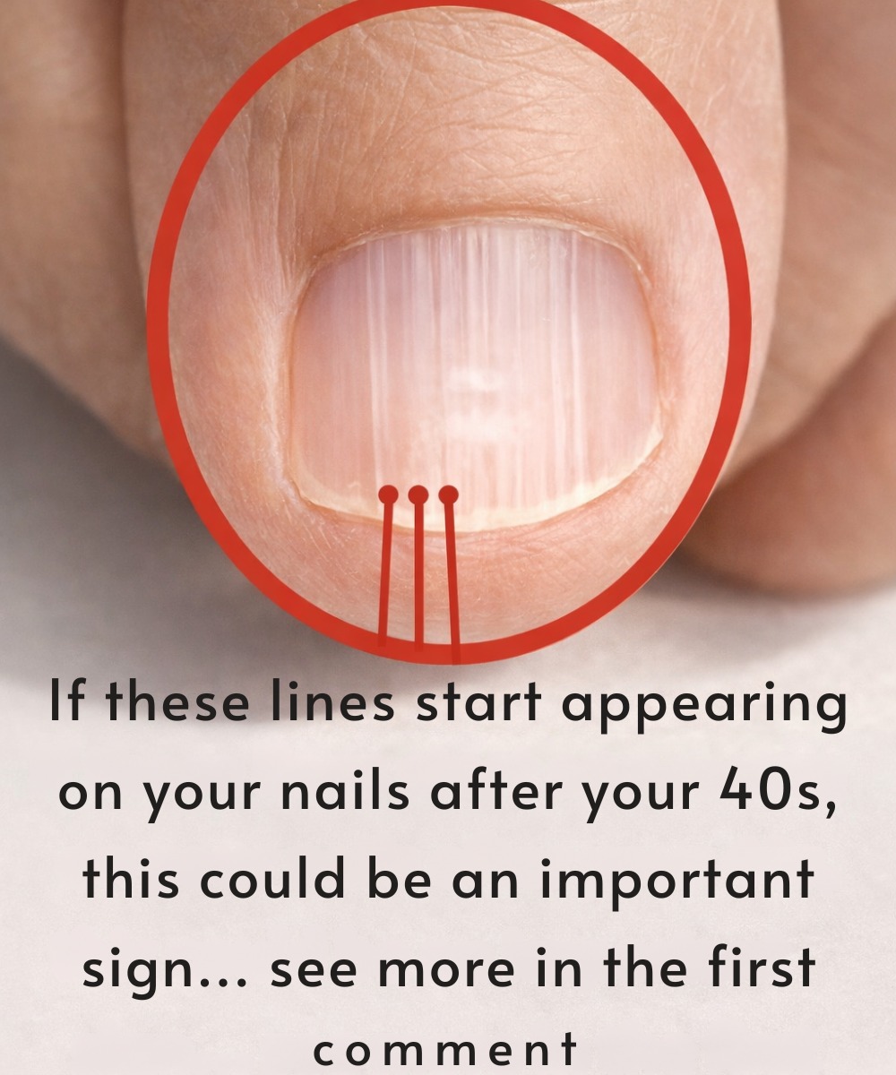 Why Do Nails Develop Ridges Vertical Ridges on Nails After 40: Why They Appear and When to Worry ...