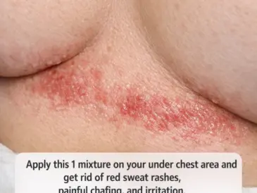 Apply this 1 mixture on your under chest area and get rid of red sweat rashes, painful chafing, and irritation.