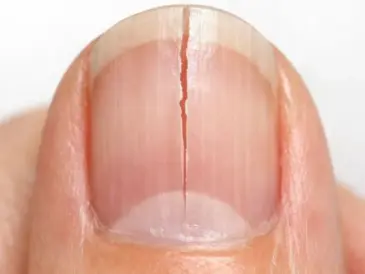 My fingernails keep splitting straight down instead of chipping. What causes this?