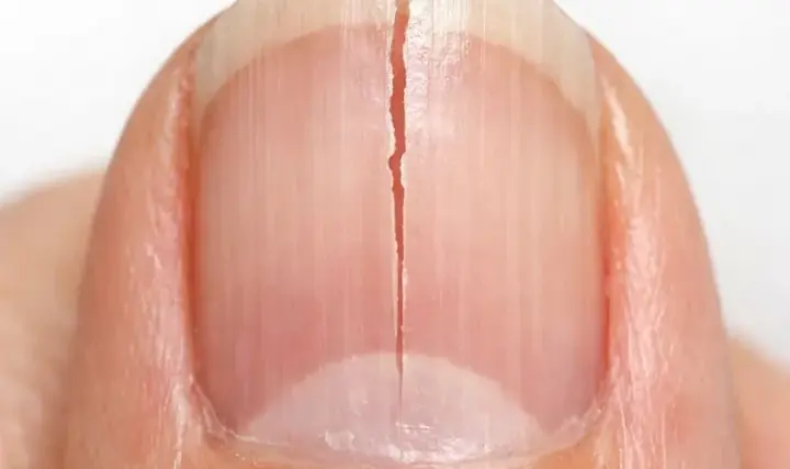 My fingernails keep splitting straight down instead of chipping. What causes this?