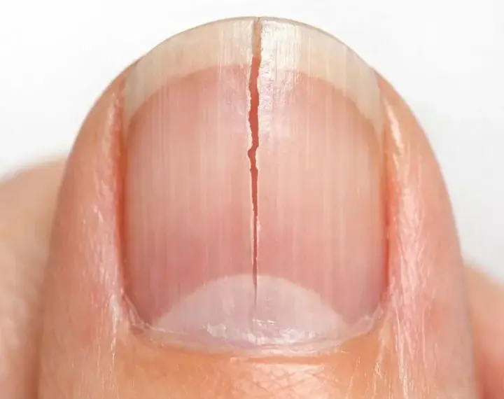 My fingernails keep splitting straight down instead of chipping. What causes this?