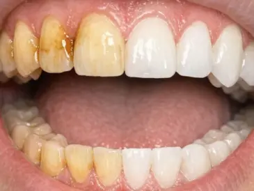 Swish this 1 mixture in your mouth and get rid of coffee stains, tea discoloration, and dull enamel