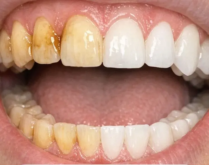Swish this 1 mixture in your mouth and get rid of coffee stains, tea discoloration, and dull enamel